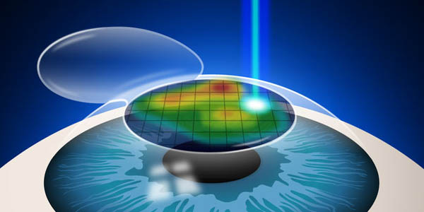 LASIK REFRACTIVE SURGERY